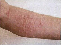 la chenille processionnaire Impact sur la santé